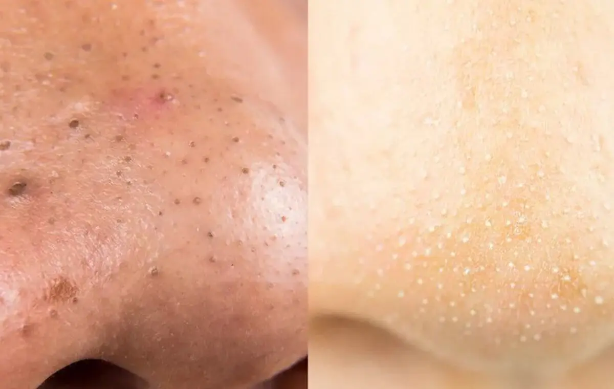 sebaceous-filaments-vs-blackheads