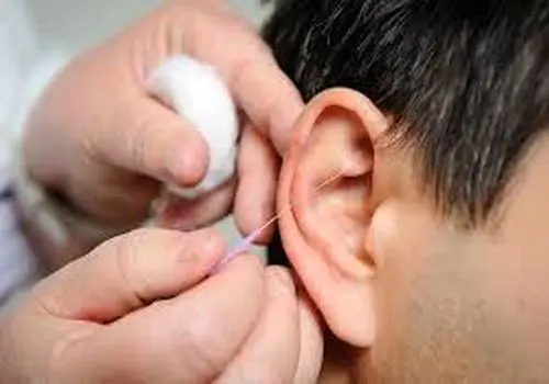 علل سوت کشیدن گوش چیست؟
