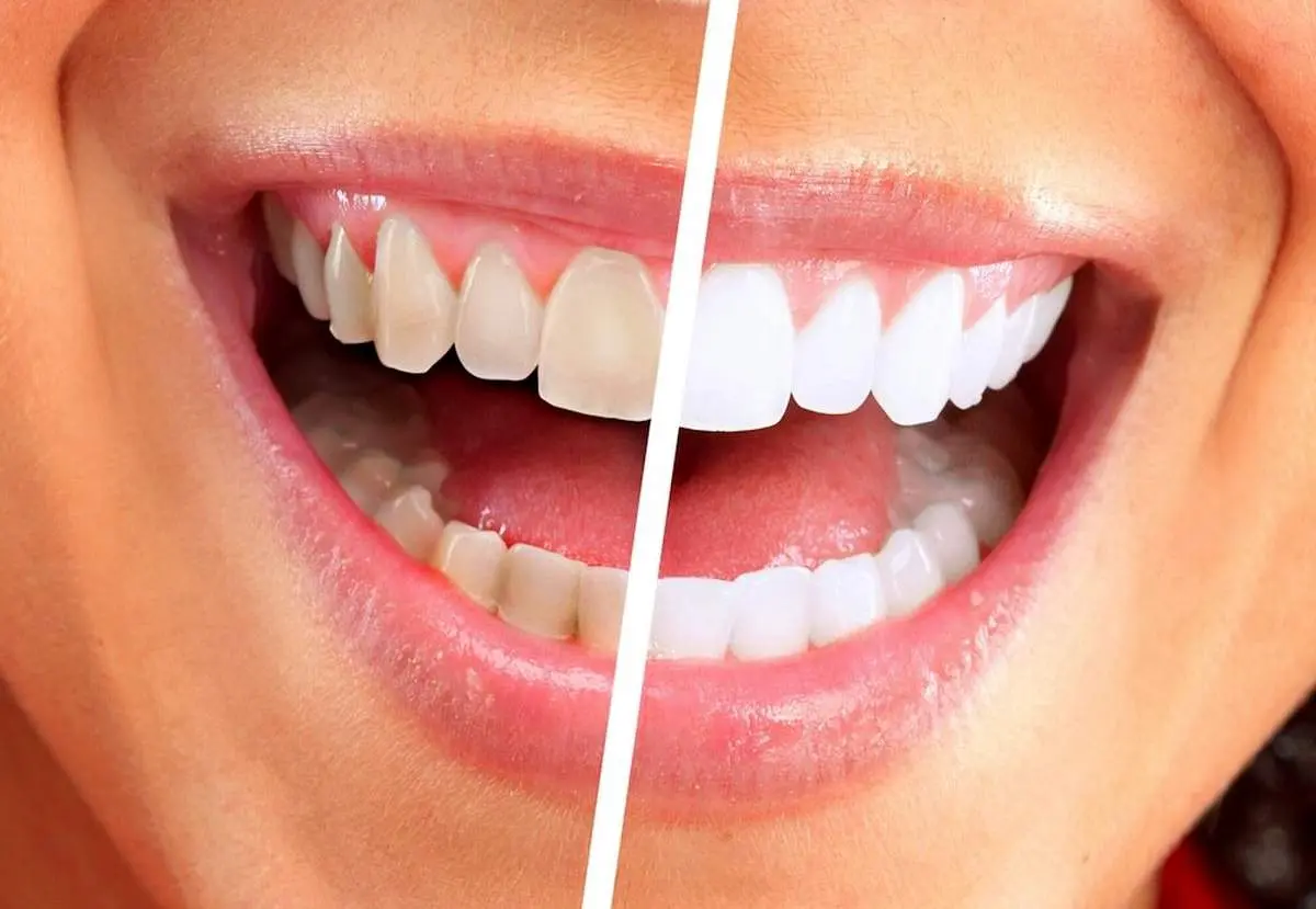 دندانها چه رازی از سلامت بدن فاش میکنند؟ | از زردی تا قهوهای، هر رنگ چه معنایی دارد؟