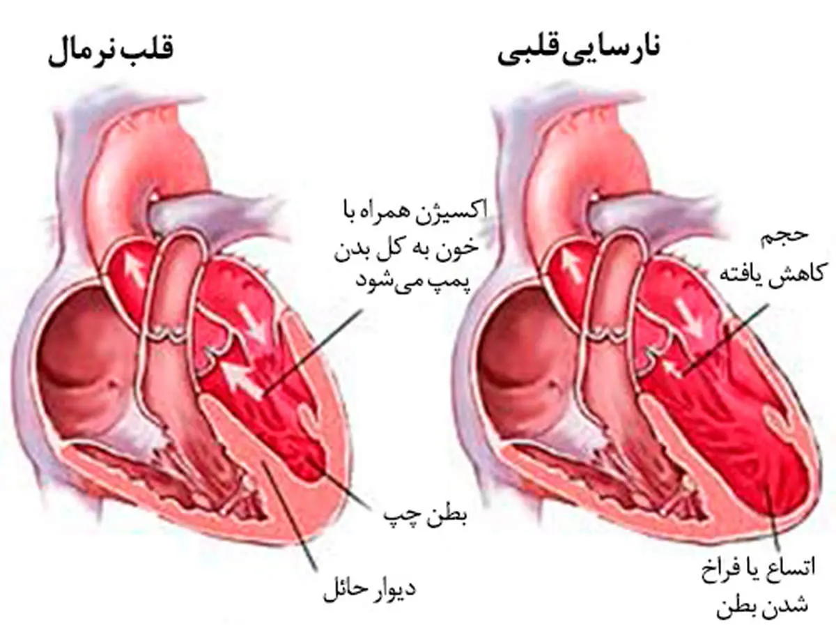 مهم ترین دلیل افزایش نارسایی قلبی چیست؟
