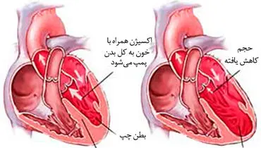 مهم ترین دلیل افزایش نارسایی قلبی چیست؟
