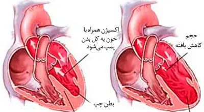 مهم ترین دلیل افزایش نارسایی قلبی چیست؟
