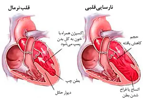 مهم ترین دلیل افزایش نارسایی قلبی چیست؟
