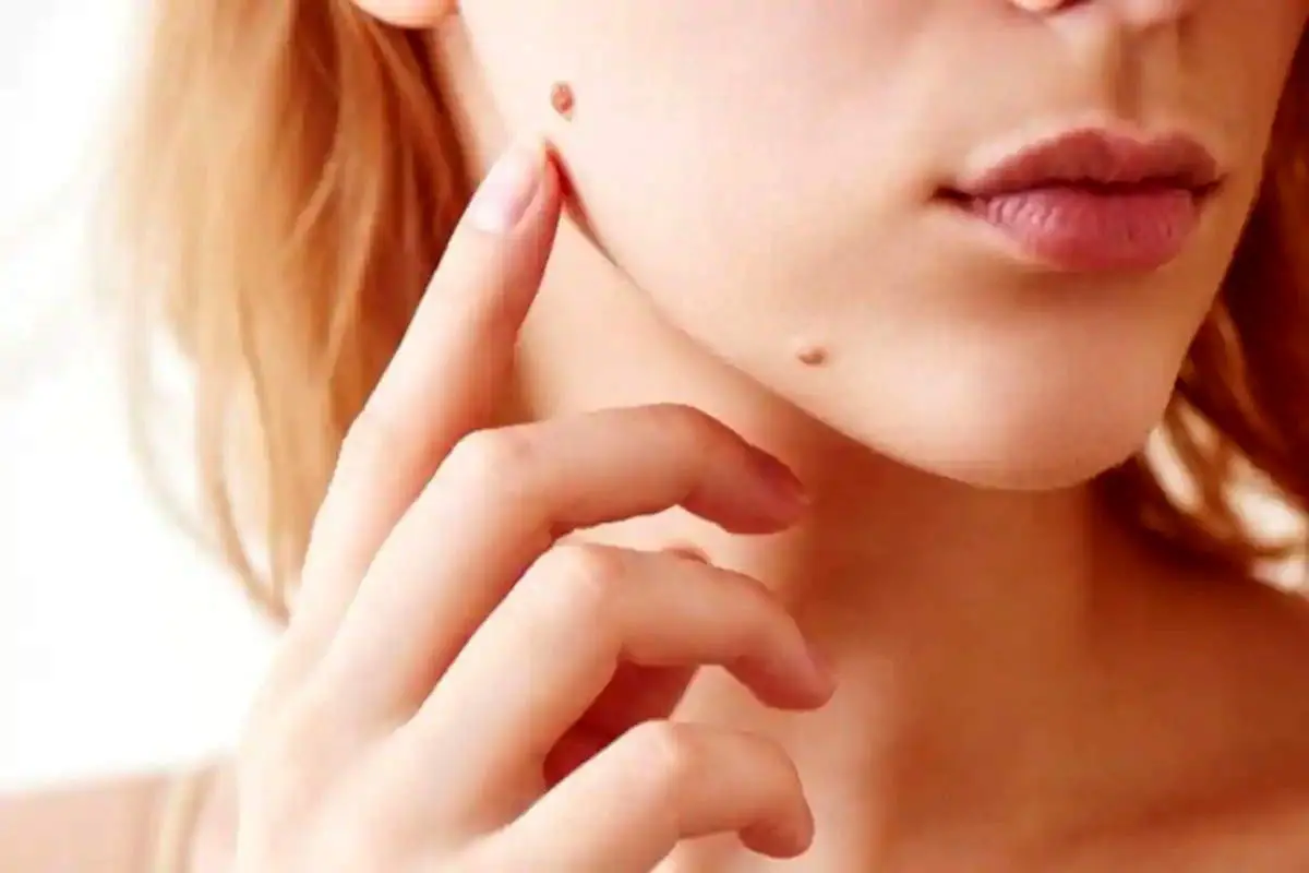 اگر خال شما این ویژگی ها را دارد باید به پزشک مراجعه کنید