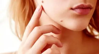 اگر خال شما این ویژگی ها را دارد باید به پزشک مراجعه کنید
