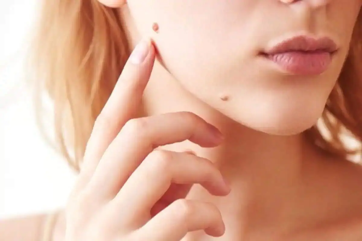 اگر خال شما این ویژگی ها را دارد باید به پزشک مراجعه کنید