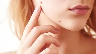 اگر خال شما این ویژگی ها را دارد باید به پزشک مراجعه کنید