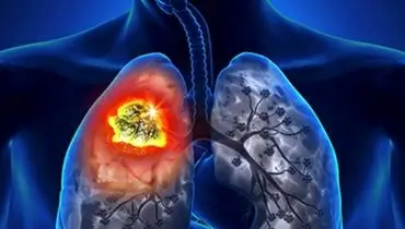 درمان سرطان ریه پیدا شد