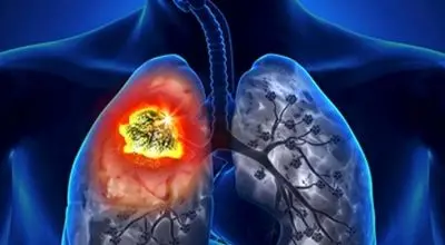 درمان سرطان ریه پیدا شد