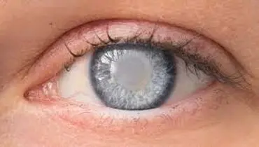 سن ابتلا به آب‌مروارید پایین آمده