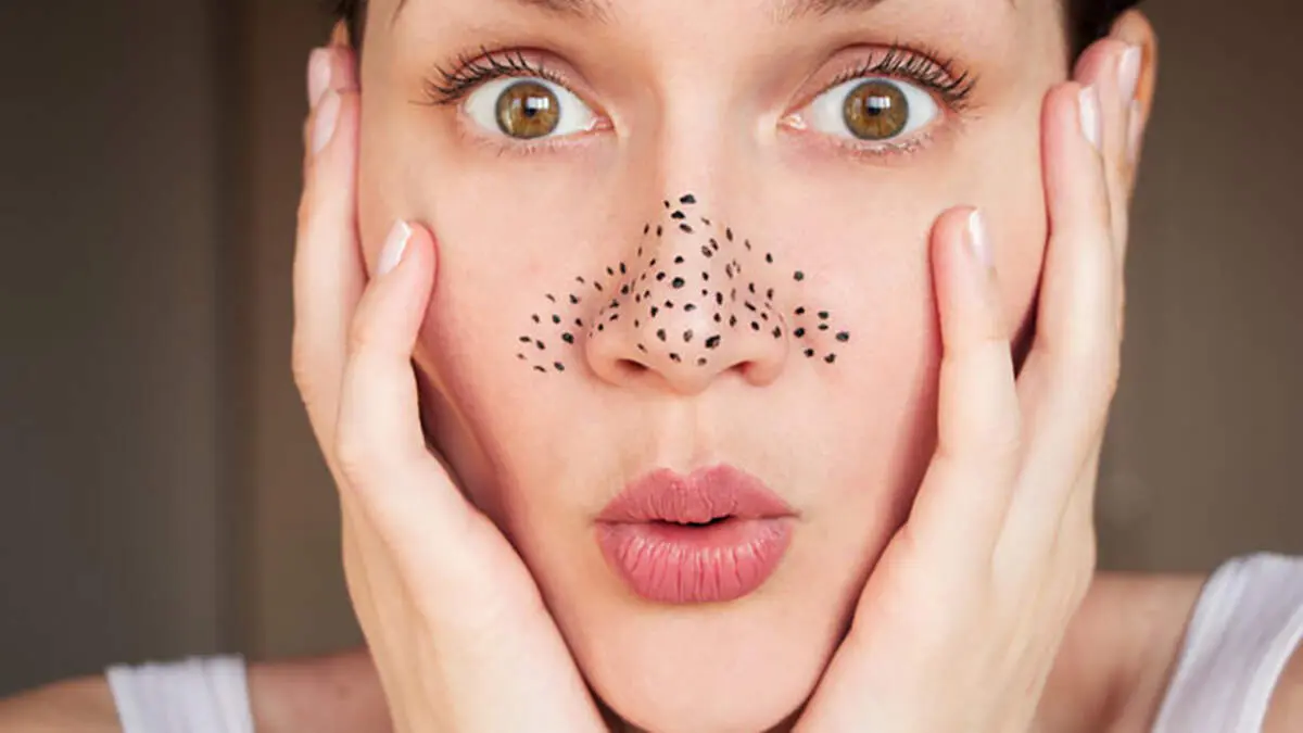 جوش سرسیاه را چگونه درمان کنیم؟