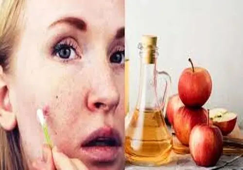 ۵ فایده شگفت‌انگیز سرکه سیب