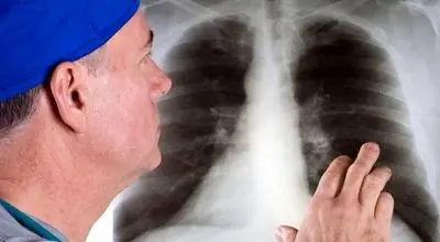 علائم هشداردهنده سرطان ریه در اندام‌ها؛ نشانه‌هایی که نباید نادیده گرفت

