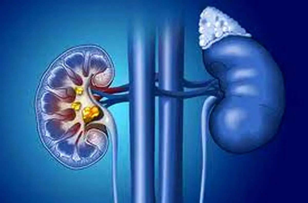  روشی موثر برای درمان سنگ کلیه ی بزرگ