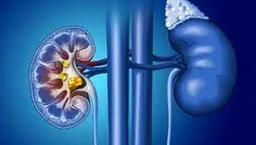  روشی موثر برای درمان سنگ کلیه ی بزرگ
