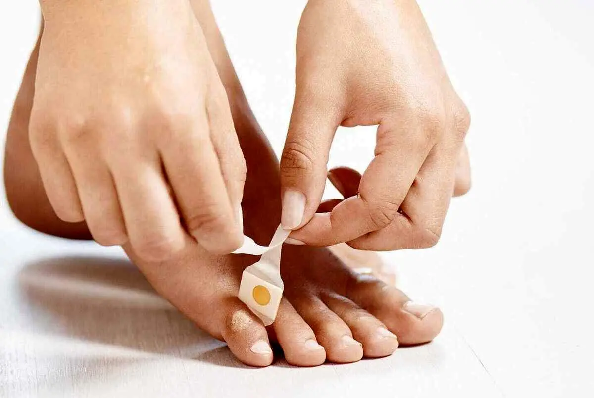 میخچه چیست چگونه درمان می‌شود؟