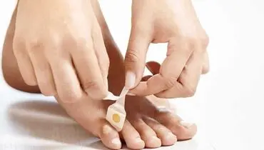 میخچه چیست چگونه درمان می‌شود؟
