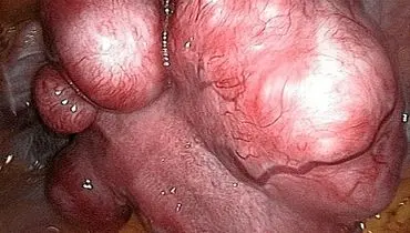 فیبروم رحمی چیست؟
