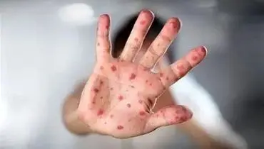 گزارش جدید سازمان جهانی بهداشت از شیوع سرخک