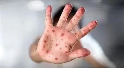 گزارش جدید سازمان جهانی بهداشت از شیوع سرخک