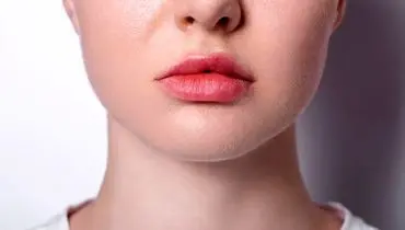 علت کج شدن لب پایین / از ژنتیک تا درمان
