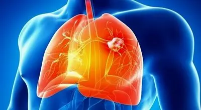 سرطان مزوتلیوما چگونه ایجاد می شود و چه علائمی دارد؟
