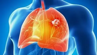 سرطان مزوتلیوما چگونه ایجاد می شود و چه علائمی دارد؟
