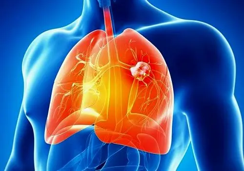 سرطان مزوتلیوما چگونه ایجاد می شود و چه علائمی دارد؟
