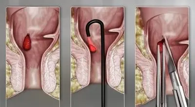 مراقبت های بعد از جراحی بواسیر که باید بدانید
