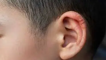 ۳ نشانه و روش درمان قطعی خارش و خشکی لاله گوش در چیست؟