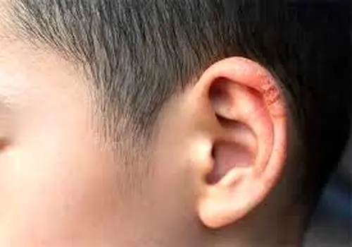 ۳ نشانه و روش درمان قطعی خارش و خشکی لاله گوش در چیست؟