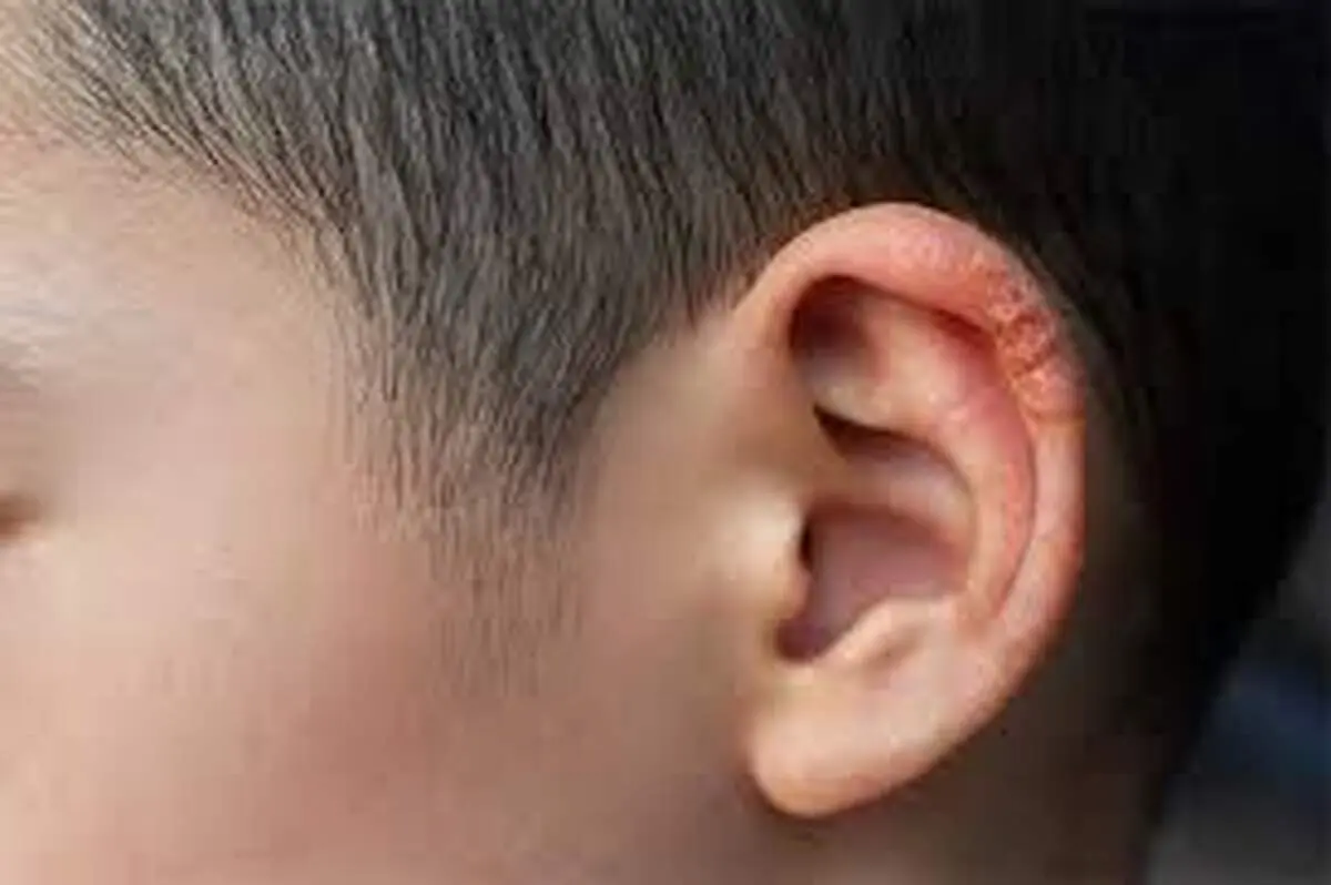 ۳ نشانه و روش درمان قطعی خارش و خشکی لاله گوش در چیست؟