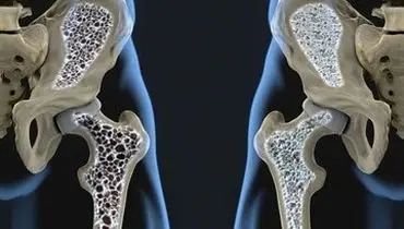 پیشگیری از پوکی استخوان با مصرف این مواد غذایی
