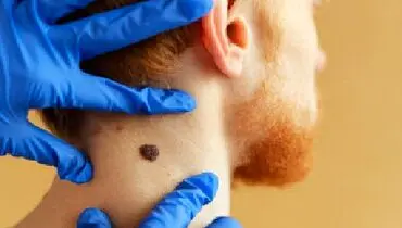 داشتن تعداد خال زیاد، خطرناک است؟