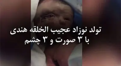 تولد نوزاد عجیب الخلقه هندی با ۳ صورت و ۳ چشم/ویدیو