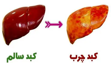 علت اصلی ابتلا به کبد چرب ؛ بهترین رژیم غذایی برای بیماران کبد چرب