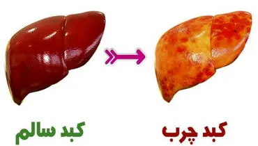 علت اصلی ابتلا به کبد چرب ؛ بهترین رژیم غذایی برای بیماران کبد چرب