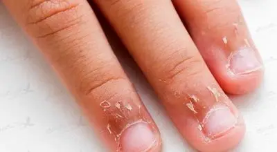 علت پوست‌پوست شدن اطراف ناخن و روش‌های درمان
