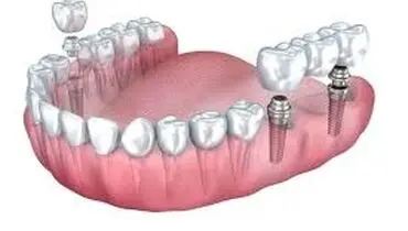  پل دندان بهتر است یا ایمپلنت؟