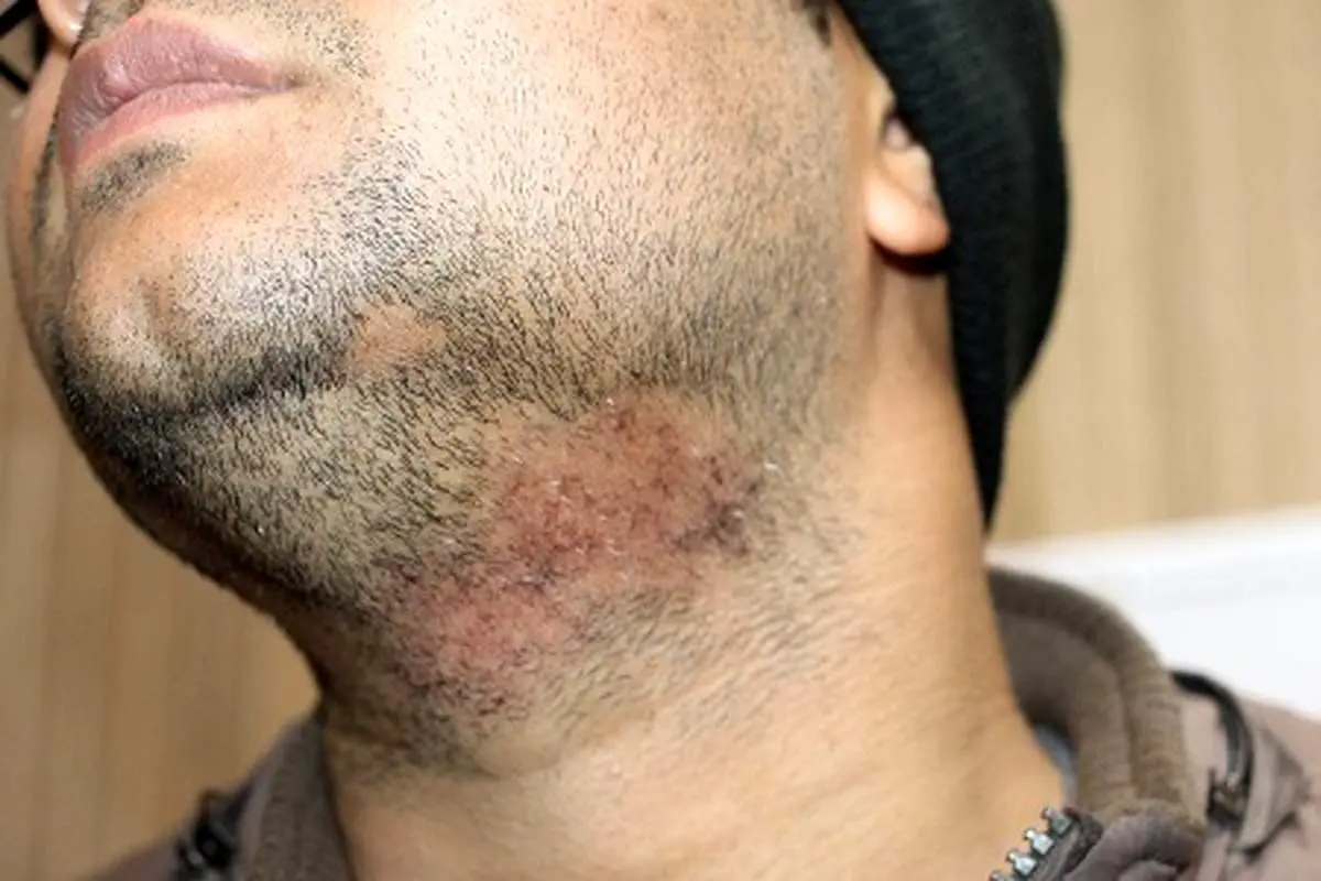 ریزش سکه ای ریش چیست ؟
