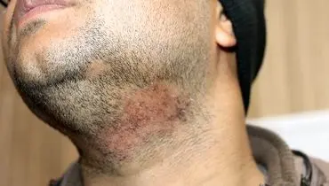 ریزش سکه ای ریش چیست ؟
