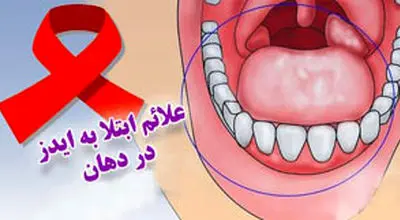 نشانه های بیماری ایدز در دهان چیست؟
