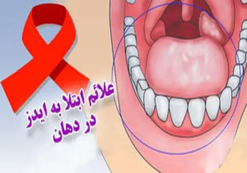 مقابله با زخم های حاد دهانی با این چاشنی شگفت انگیز
