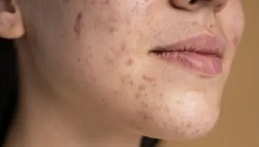 با این روغن با لک صورتتان خداحافظی کنید