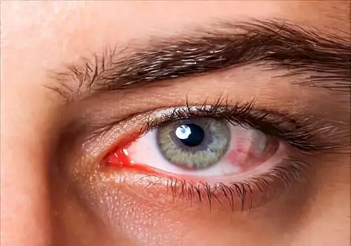 چگونه با پشه آئدس و تب دنگی مقابله کنیم؟ +اینفوگرافی