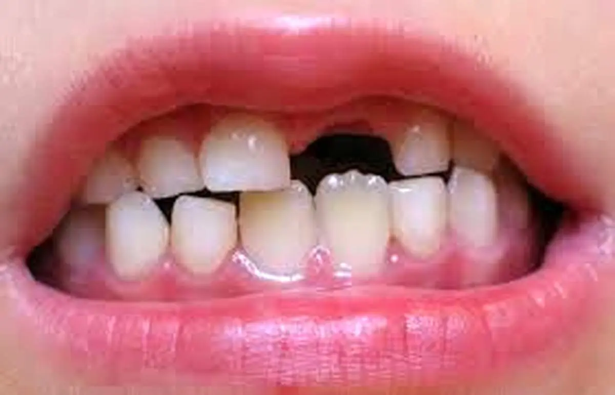 علت در نیامدن دندان بعد از افتادن دندان شیری
