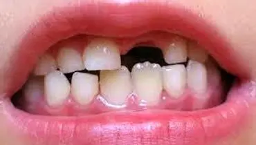 علت در نیامدن دندان بعد از افتادن دندان شیری
