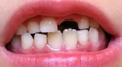 علت در نیامدن دندان بعد از افتادن دندان شیری
