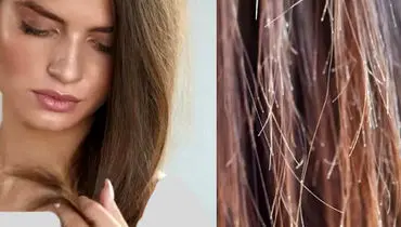 چگونه از موخوره جلوگیری کنیم؟
