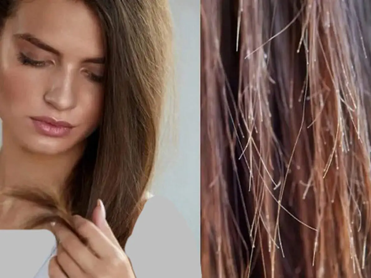 چگونه از موخوره جلوگیری کنیم؟